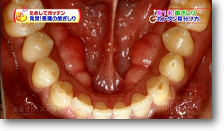 歯茎の変形 歯茎の変形