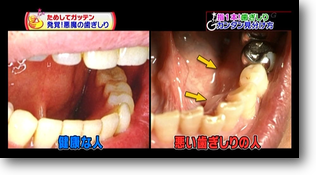 健康な歯茎と不健康な歯茎 健康な歯茎と不健康な歯茎